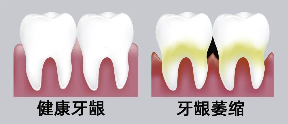 牙縫大露出“黑三角”，既塞牙又難看！還能恢復(fù)嗎？